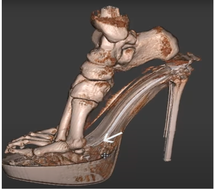 How to Treat Bunions without Surgery
